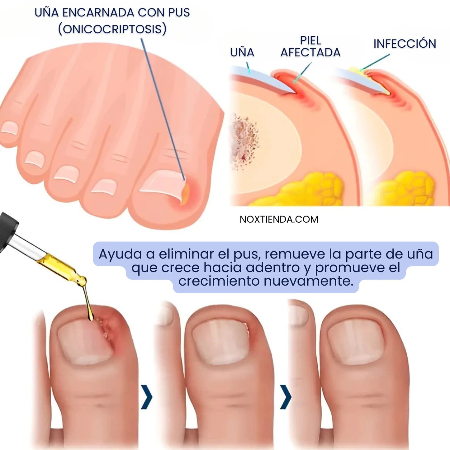 Aceite Anti Hongos ToeNailPlus® x2